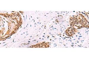 Immunohistochemistry of paraffin-embedded Human esophagus cancer tissue using CREBBP Polyclonal Antibody at dilution of 1:35(x200) (CBP 抗体)