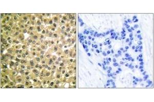 Immunohistochemistry analysis of paraffin-embedded human breast carcinoma tissue, using Retinoic Acid Receptor beta Antibody. (Retinoic Acid Receptor beta 抗体  (AA 331-380))