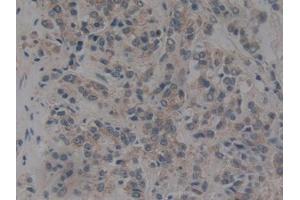 IHC-P analysis of Human Prostate cancer Tissue, with DAB staining. (NUP153 抗体  (AA 1238-1468))