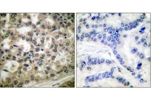 Immunohistochemistry analysis of paraffin-embedded human lung carcinoma, using IkappaB-beta (Phospho-Ser23) Antibody. (NFKBIB 抗体  (pSer23))
