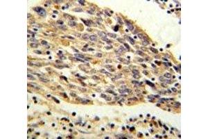 PKM2 antibody IHC analysis in formalin fixed and paraffin embedded human lung carcinoma. (PKM2 抗体  (AA 116-145))
