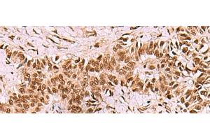 Immunohistochemistry of paraffin-embedded Human ovarian cancer tissue using LDB1 Polyclonal Antibody at dilution of 1:70(x200) (LIM Domain Binding 1 Protein 抗体)