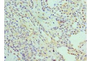 Immunohistochemistry of paraffin-embedded human breast cancer using ABIN7142216 at dilution of 1:100