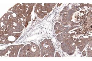 IHC-P Image Immunohistochemical analysis of paraffin-embedded Gastric CA N87 xenograft, using CDA, antibody at 1:100 dilution. (CDA 抗体)