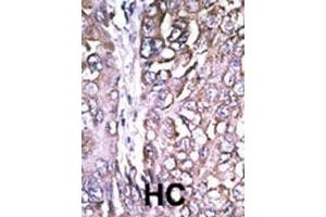 Formalin-fixed and paraffin-embedded human cancer tissue reacted with the primary antibody, which was peroxidase-conjugated to the secondary antibody, followed by AEC staining. (ATG4A 抗体  (AA 82-111))