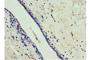 Immunohistochemistry of paraffin-embedded human breast cancer using ABIN7146735 at dilution of 1:100 (CA8 抗体  (AA 1-290))