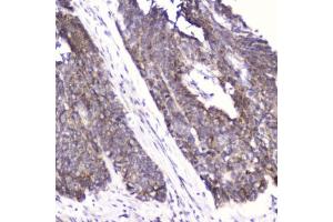 IHC testing of FFPE human esophageal squamous cell carcinoma with FABP3 antibody at 2ug/ml. (FABP3 抗体  (AA 2-133))