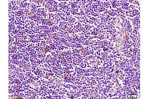 Formalin-fixed and paraffin embedded human pancreatic cancer tissue labeled with Anti-CD1A Polyclonal Antibody, Unconjugated (ABIN702700) at 1:200 followed by conjugation to the secondary antibody and DAB staining (CD1d1 抗体  (AA 51-150))