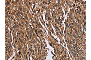 The image on the left is immunohistochemistry of paraffin-embedded Human lung cancer tissue using ABIN7129718(HMGN5 Antibody) at dilution 1/20, on the right is treated with fusion protein. (HMGN5 抗体)