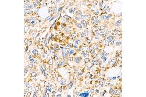 Immunohistochemistry analysis of paraffin-embedded human ovary cancer using Torsin A (ABIN7075942) at dilution of 1:800 (TOR1A 抗体)