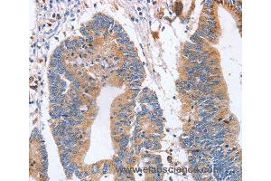 Immunohistochemistry of Human colon cancer using SIGLEC6 Polyclonal Antibody at dilution of 1:70 (SIGLEC6 抗体)