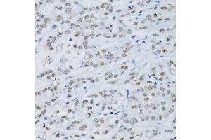 Immunohistochemistry of paraffin-embedded human colon carcinoma using SNRNP70 antibody. (SNRNP70 抗体  (AA 150-250))