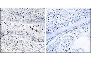 Immunohistochemistry analysis of paraffin-embedded human lung carcinoma tissue, using EZH1 Antibody. (EZH1 抗体  (AA 171-220))