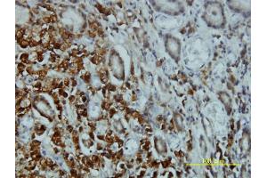 Immunoperoxidase of monoclonal antibody to STK4 on formalin-fixed paraffin-embedded human stomach carcinoma tissue. (STK4 抗体  (AA 1-39))