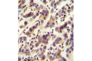 Immunohistochemistry analysis in formalin fixed and paraffin embedded human testis carcinoma reacted with OR1J4 Antibody (C-term) followed which was peroxidase conjugated to the secondary antibody and followed by DAB staining. (OR1J4 抗体  (C-Term))