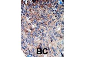 Immunohistochemistry (Paraffin-embedded Sections) (IHC (p)) image for anti-Non-Metastatic Cells 1, Protein (NM23A) Expressed in (NME1) (AA 25-54), (N-Term) antibody (ABIN392655)