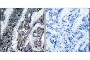 Immunohistochemistry analysis of paraffin-embedded human breast carcinoma, using HER2 (Phospho-Tyr1248) Antibody. (ErbB2/Her2 抗体  (pTyr1248))