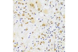 Immunohistochemistry of paraffin-embedded human liver cancer using HNRNPA1 Antibody (ABIN5975570) at dilution of 1/100 (40x lens). (HNRNPA1 抗体)