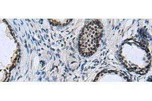 Immunohistochemistry of paraffin-embedded Human prost at e cancer tissue using CCAR2 Polyclonal Antibody at dilution of 1:40(x200) (CCAR2 抗体)