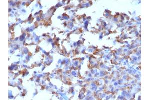 Formalin-fixed, paraffin-embedded human Histiocytoma stained with CD163-Monospecific Mouse Monoclonal Antibody (M130/2162). (CD163 抗体  (AA 43-196))
