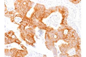 Formalin-fixed, paraffin-embedded human Colorectal Carcinoma stained with Ep-CAM Mouse Monoclonal Antibody (EGP40/1798). (EpCAM 抗体  (Extracellular Domain))