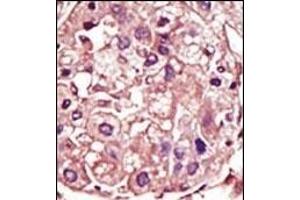 Formalin-fixed and paraffin-embedded human cancer tissue reacted with the primary antibody, which was peroxidase-conjugated to the secondary antibody, followed by AEC staining. (TGFBR1 抗体  (AA 134-163))