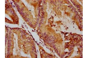 IHC image of ABIN7170939 diluted at 1:400 and staining in paraffin-embedded human endometrial cancer performed on a Leica BondTM system. (QSOX1 抗体  (AA 101-175))