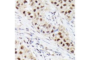 Immunohistochemistry of paraffin-embedded human breast cancer using [KO Validated] CDK4 Rabbit mAb  at dilution of 1:100 (40x lens). (CDK4 抗体)