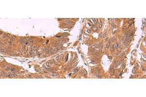 Immunohistochemistry of paraffin-embedded Human colorectal cancer tissue using ZBTB33 Polyclonal Antibody at dilution of 1:30(x200) (ZBTB33 抗体)