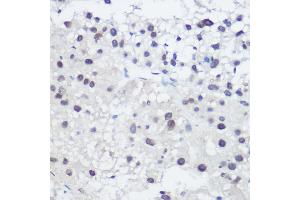 Immunohistochemistry of paraffin-embedded human liver cancer using GA Rabbit pAb (ABIN3022563, ABIN3022564, ABIN3022565, ABIN1679943 and ABIN6218905) at dilution of 1:200 (40x lens). (GADD45A 抗体  (AA 1-165))