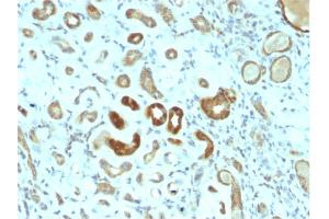 Formalin-fixed, paraffin-embedded human Renal Cell Carcinoma stained with STAT3 Mouse Monoclonal Antibody (STAT3/2409). (STAT3 抗体)