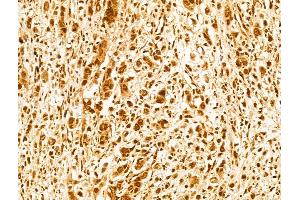 ABIN7094227 and ABIN7098274 at 1/100 staining Human gastric cancer by IHC-P.