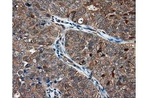Immunohistochemical staining of paraffin-embedded Adenocarcinoma of ovary tissue using anti-NIT1 mouse monoclonal antibody. (Nitrilase 1 抗体)