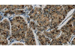 Immunohistochemistry of paraffin-embedded Human breast cancer tissue using DNA Ligase1 Polyclonal Antibody at dilution 1:70 (LIG1 抗体)