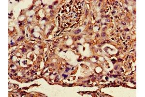 Immunohistochemistry of paraffin-embedded human lung cancer using ABIN7145421 at dilution of 1:100 (beta-2 Microglobulin 抗体  (AA 21-119))