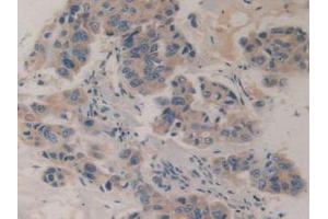 IHC-P analysis of Human Breast Cancer Tissue, with DAB staining. (CHGB 抗体  (AA 496-669))
