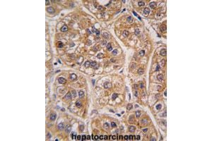 Formalin-fixed and paraffin-embedded human hepatocarcinomareacted with AKR1A1 polyclonal antibody , which was peroxidase-conjugated to the secondary antibody, followed by AEC staining. (AKR1A1 抗体  (C-Term))