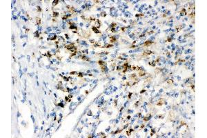 IHC(P): Human Intestinal Cancer Tissue (PPT1 抗体  (C-Term))