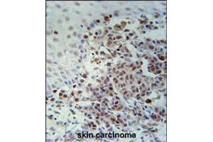 XRCC1 Antibody immunohistochemistry analysis in formalin fixed and paraffin embedded human skin carcinoma followed by peroxidase conjugation of the secondary antibody and DAB staining. (XRCC1 抗体  (AA 407-435))