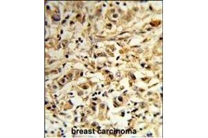 Forlin-fixed and paraffin-embedded hun breast carcino reacted with T2B Antibody (N-term), which was peroxidase-conjugated to the secondary antibody, followed by DAB staining. (MAT2B 抗体  (N-Term))