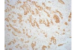IHC staining of mouse prostate adenocarcinoma tissue, diluted at 1:200. (AMACR 抗体)