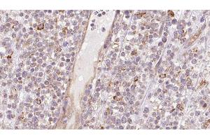 ABIN6273205 at 1/100 staining Human lymph cancer tissue by IHC-P. (CCBL1 抗体  (Internal Region))