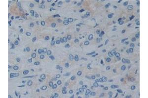 DAB staining on IHC-P;;Samples: Human Prostate cancer Tissue (Reelin 抗体  (AA 2398-2608))