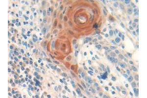 DAB staining on IHC-P; Samples: Human Skin cancer Tissue (Follistatin 抗体  (AA 35-283))