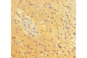 Immunohistochemistry of paraffin-embedded human glioma using ABIN7164055 at dilution of 1:100 (POU3F2 抗体  (AA 1-443))