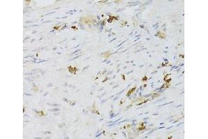 Immunohistochemistry of paraffin-embedded Human adenomyosis using LSP1 Polyclonal Antibody at dilution of 1:100 (40x lens). (LSP1 抗体)