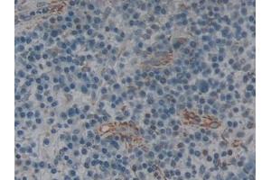 Detection of IL2Ra in Human Skin cancer Tissue using Polyclonal Antibody to Interleukin 2 Receptor Alpha (IL2Ra) (CD25 抗体  (AA 22-213))