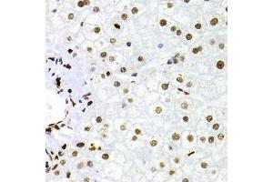 Immunohistochemistry of paraffin-embedded human liver injury using NFKB2 Antibody (ABIN1873900) at dilution of 1:100 (40x lens). (NFKB2 抗体)