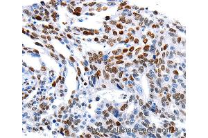 Immunohistochemistry of Human ovarian cancer using MUTYH Polyclonal Antibody at dilution of 1:60 (MUTYH 抗体)