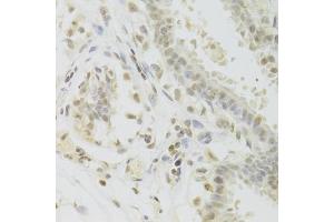 Immunohistochemistry of paraffin-embedded human breast using PRPF3 Antibody (ABIN5973192) at dilution of 1/100 (40x lens). (PRPF3 抗体)
